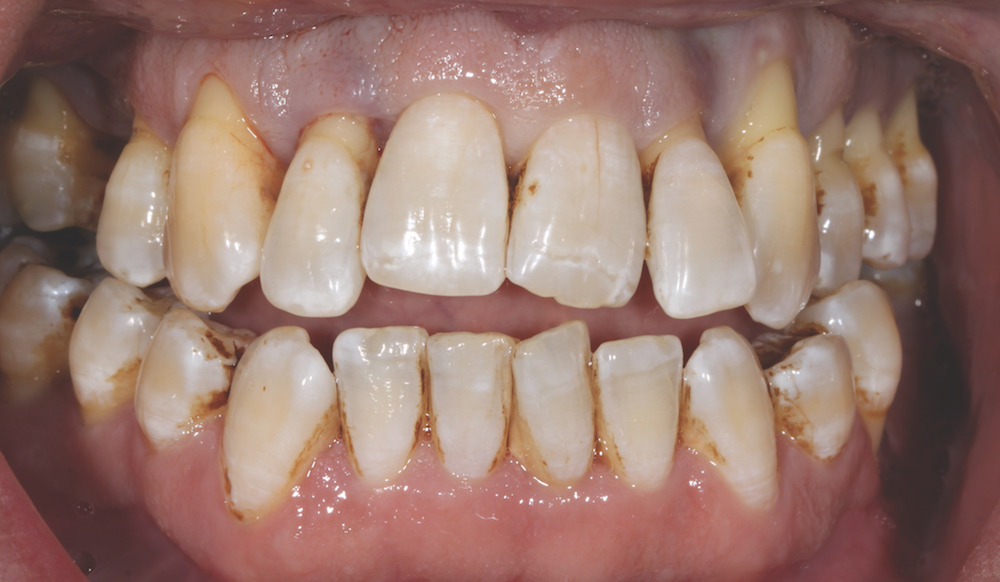 Same Day Teeth Implants Winchester