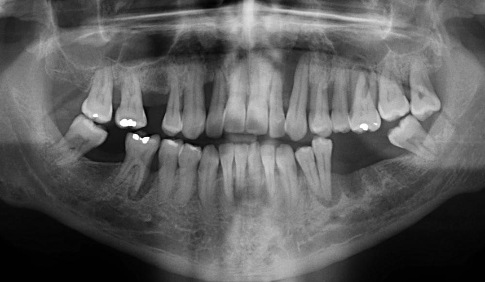X-ray of teeth before treatment - Solutions Dental Clinic Winchester