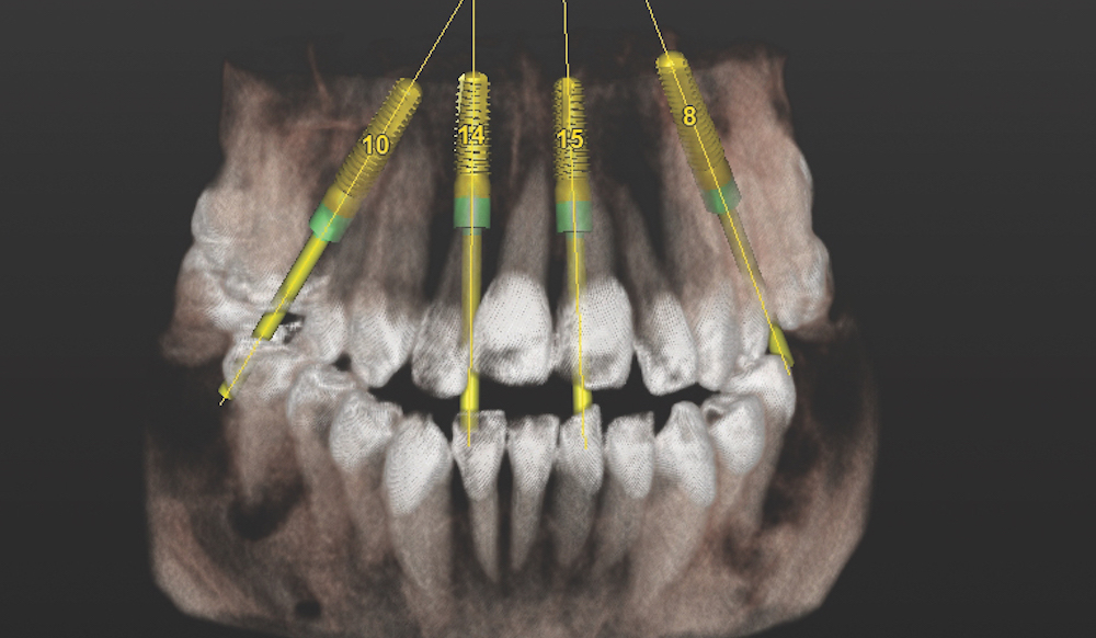 3D - digital CT planning - Solutions Dental Clinic Winchester
