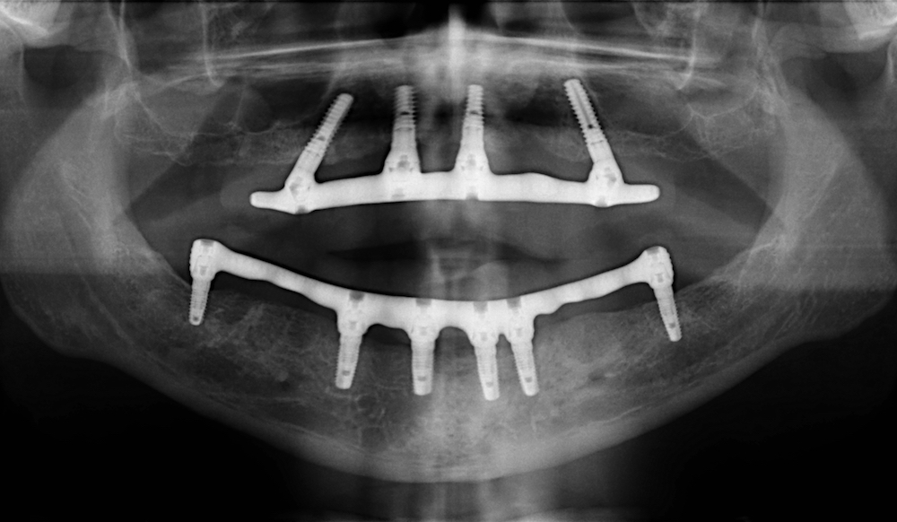 X-ray showing implants in place - Solutions Dental Clinic Winchester